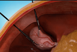 Percuvance percutaneous surgical system for Minimal Access Surgery