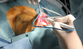 Trans Oral Video Endoscopic Surgery (TOVES)