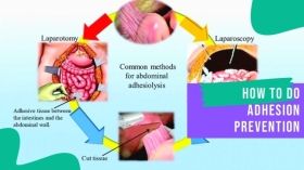 Adhesion Prevention during Laparoscopic Surgery