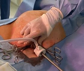 Recent updates on Increasing use of Hernioscopy 