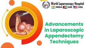 Advancements in Laparoscopic Appendectomy Techniques
