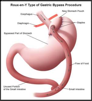 Gastric Bypass