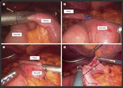 Bowel Anastomosis