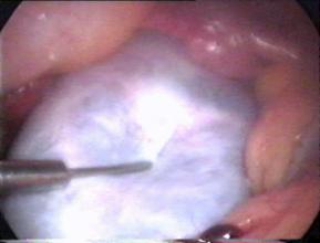 Ovarian Cyst is aspirated for ovarian cystectomy