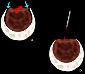 Deroofing and martipialization for Endometrioma