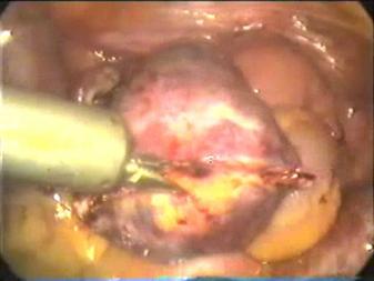 Extraction of Ovary