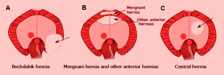 Image result for Parasternal hernia of Morgagni