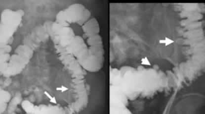 Diverticulosis
