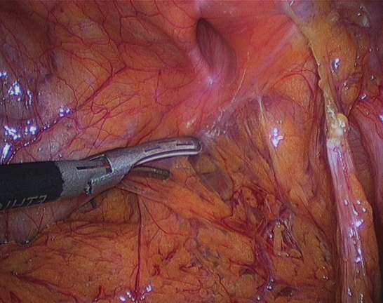 Frequently Asked Questions on Operative Technique of Laparoscopic Repair of Femoral  Hernia