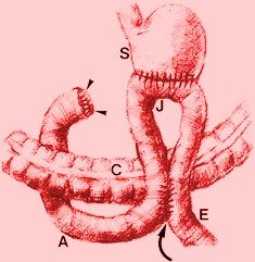 Gastroduodenostomy