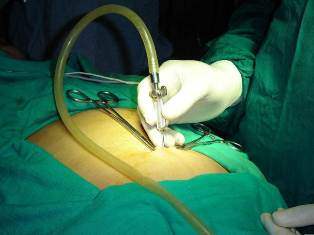 Incision