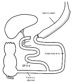 Antrectomy