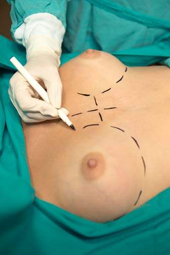 Breast Enlargement Surgery