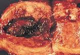 Cancer Uterus