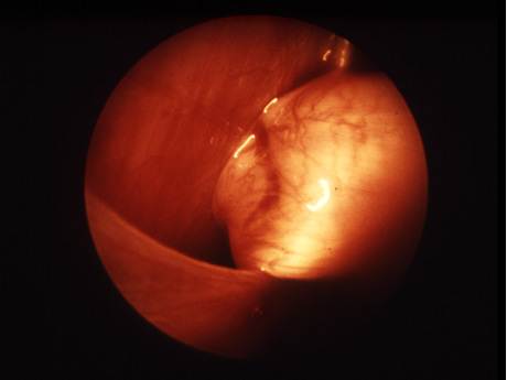 Congenital diaphragmatic Hernia