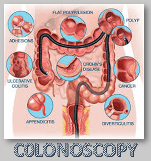 colonoscopy