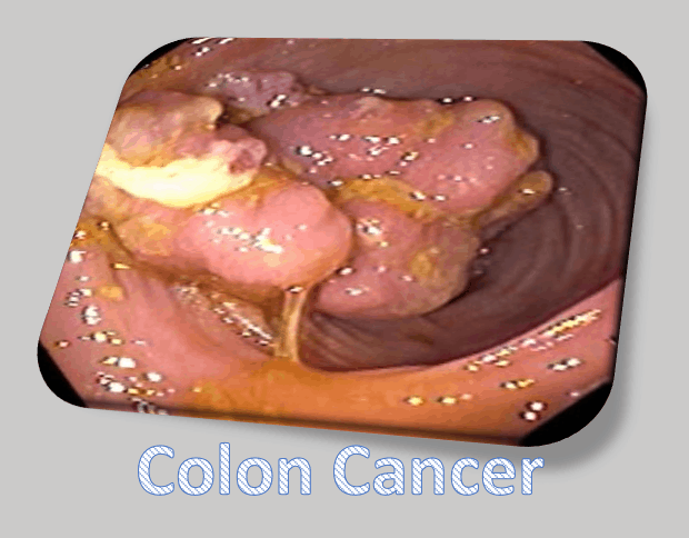 cancer colon laparoscopia)