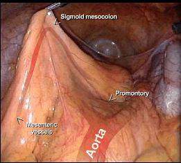 Laparoscopic Colorectal Surgery