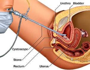 Cystoscopy