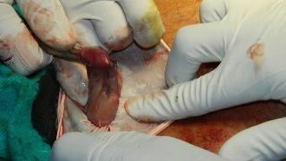 Extraction of Infected Gallbladder