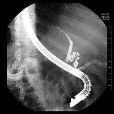 EndoscopyERCP