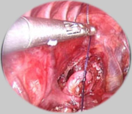 Thoracoscopic Esophageal Atresia Surgery