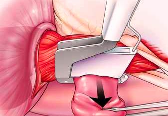 Esophagectomy