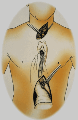 Esophagectomy