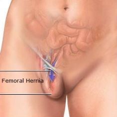 Femoral hernia repair