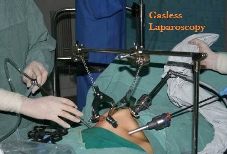 Gasless Laparoscopic Surgery