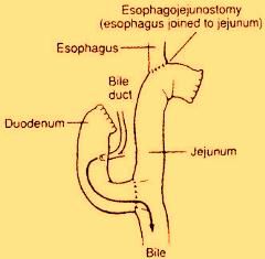 Gastrectomy