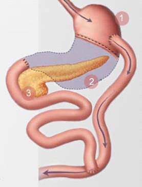 Roux En Y Gastric Bypass