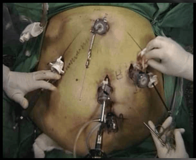 Laparoscopic Gastric Bypass