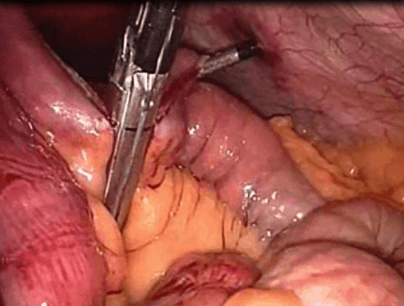Laparoscopic Gastric Bypass