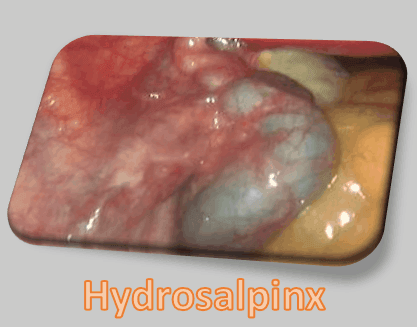 Laparoscopic Management of Hydrosalpinx