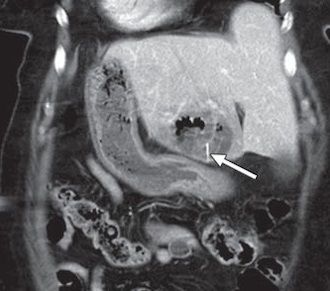 Laparoscopic Liver Surgery