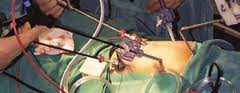 Minimally Invasive Surgery