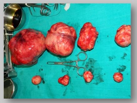 Myomectomy for intramural myoma 