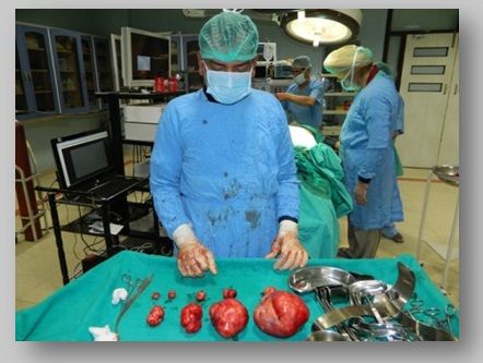 Multiple Intramural Fibroid