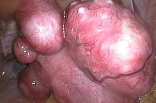 Myomectomy