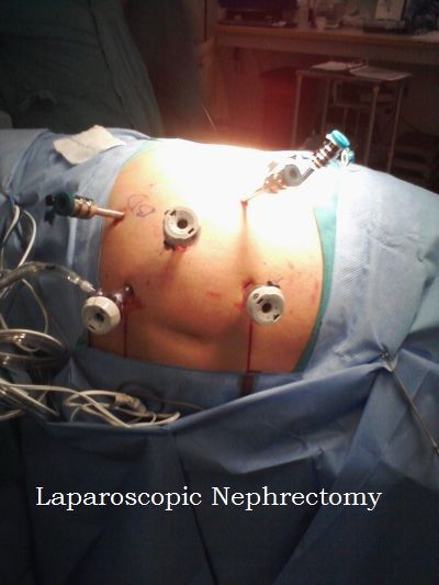 Laparoscopic Nephrectomy