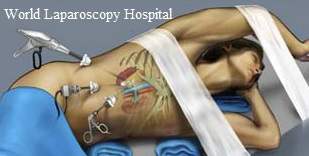 Nephrectomy