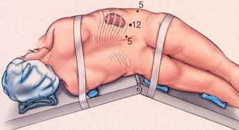 Nephrectomy