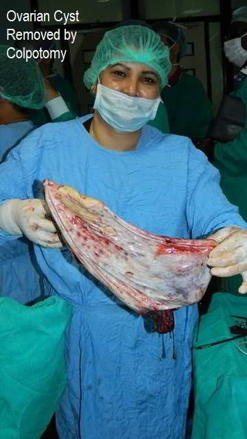 Removal of Huge Ovarian Cyst