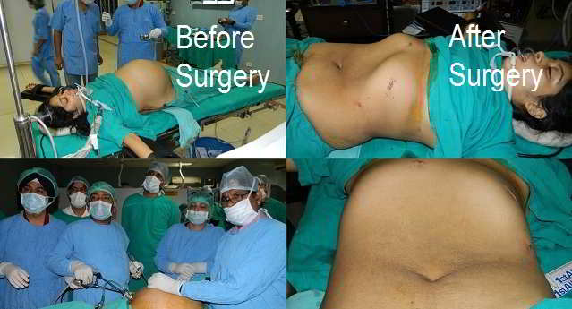 Laparoscopic Ovarian Cystectomy