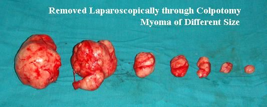 fibroid
