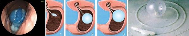 Gastric Ballooning