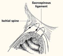 Ischial Spine
