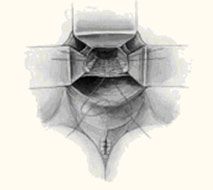 Ischial Spine