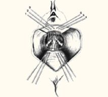 Ischial Spine